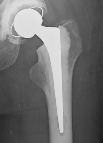 Total Hip Replacement London