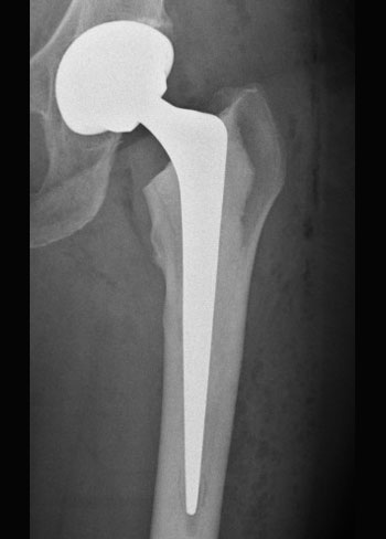 Total Hip Replacement London