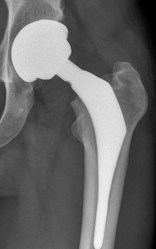 Custon-Hip Xray