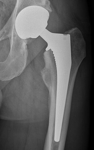 Total Hip Replacement London