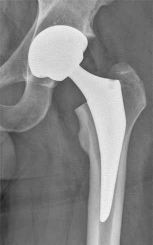 Total Hip Replacement London